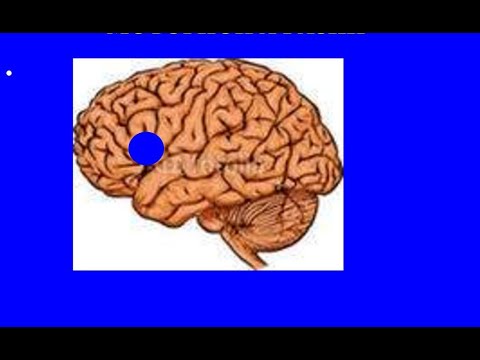 Видео: Инсульт. Восстановление речи. Аккустико-гностическая (сенсорная) афазия. Первые уроки