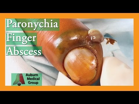 Видео: Паронихия Fingernail абсцесс инфекции лечение