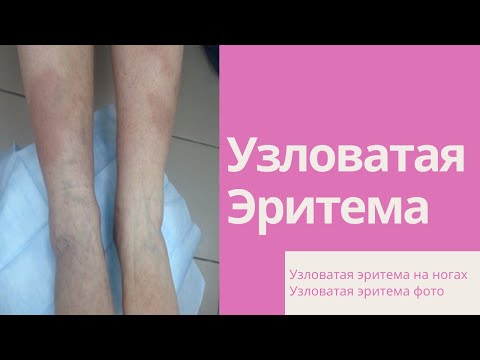Видео: Узловатая эритема