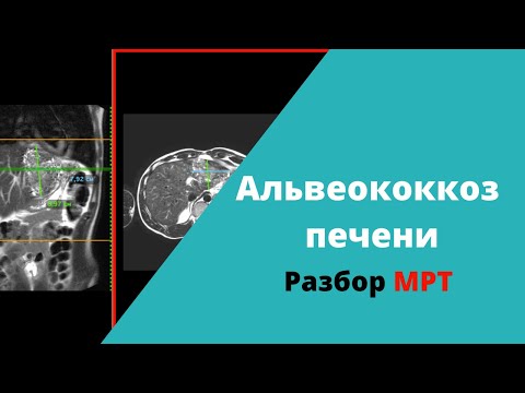 Видео: Альвеококкоз печени (разбор МРТ)