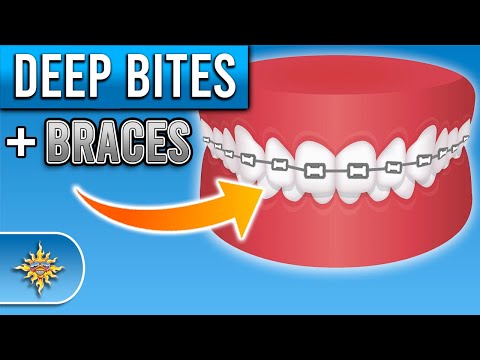 Видео: Как брекеты исправляют глубокий прикус? | Premier Orthodontics