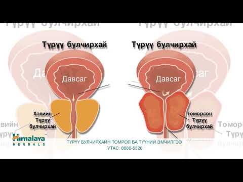 Видео: Түрүү булчирхайн томрол ба түүний эмчилгээ
