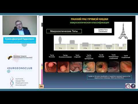 Видео: Конференция "Рак прямой кишки: яблоко раздора или зерна истины?" ЗАЛ 1 Ранний рак прямой кишки