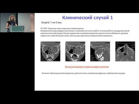 Видео: 17.02.2017 - Синусит. Педиатр вместе с ЛОР-врачом: борьба за здоровый респираторный тракт.