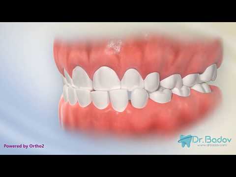 Видео: #обратназахапка #детскиортодонт #ортодонт Кръстосана (обратна) захапка при резци и дъвкателни зъби