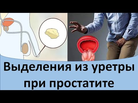 Видео: Выделения из уретры при простатите