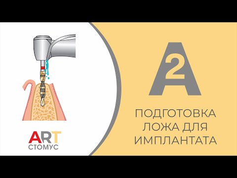 Видео: ПОДГОТОВКА ЛОЖА ДЛЯ ИМПЛАНТАТА А2