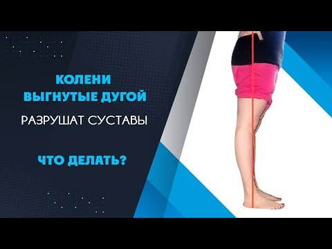 Видео: Что делать при рекурвации коленей? Колени выгибаются назад. Опасно ли это?