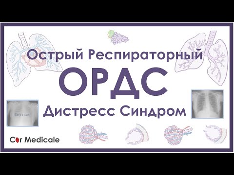 Видео: Острый респираторный дистресс синдром - ОРДС - механизм развития, причины, патофизиология