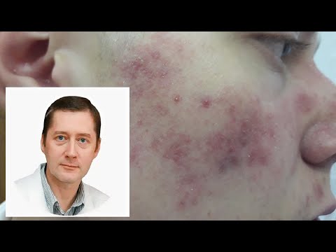 Видео: Пациент с акне: работа для дерматолога и терапевта (проф.Соколовский Е.В.)