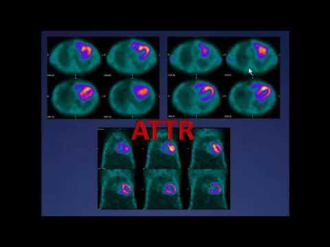 Видео: Макурова Т.В. «Сцинтиграфическая диагностика амилоидоза сердца»