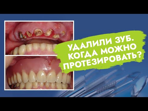 Видео: Удалили зуб. Когда можно протезировать?