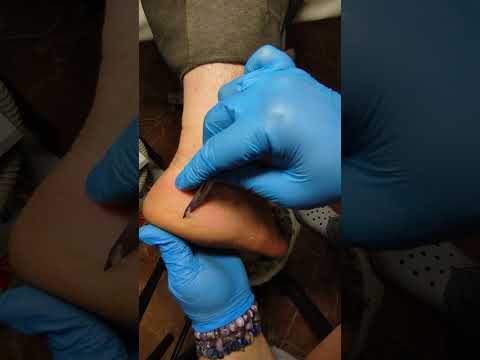 Видео: Омозолелости пяток: применение скальпеля