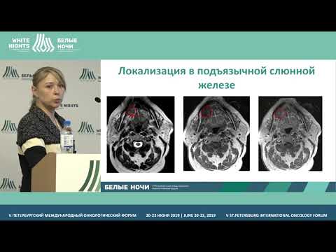 Видео: Дифференциальная диагностика Опухоль слюнных желёз (Пономарева О.И.)