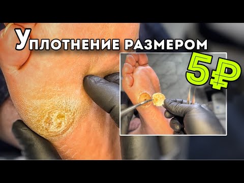 Видео: Кожное уплотнение со следами гематом у основания. Приехал за помощью с другого города