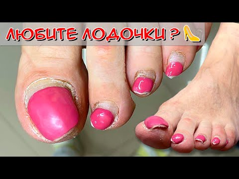 Видео: Онихолизис ногтей на ногах / Кератоз ногтей