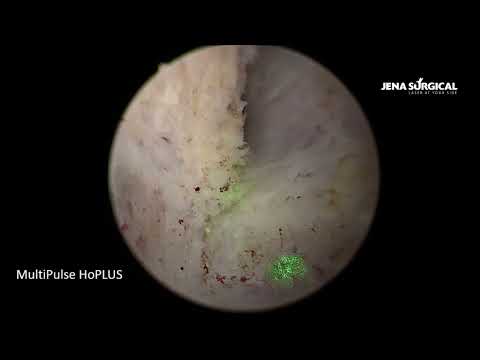 Видео: HoLEP. Лазерная энуклеация аденомы объемом 60 см³. MultiPulse HoPLUS (JENA Surgical)