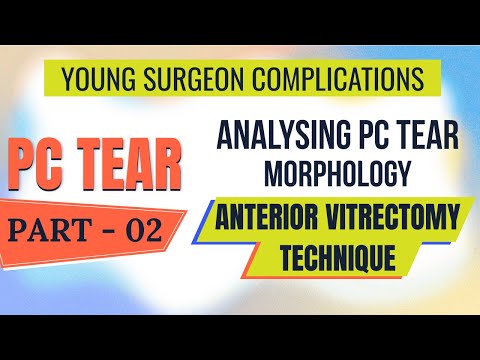 Видео: Разрыв ПК - Часть: 2 Анализ морфологии разрыва ПК, техника передней витрэктомии, имплантация ИОЛ