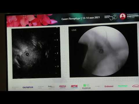 Видео: 49 Live Коржева ИЮ Бронхоскопия rEBUS TBNA трансбронхиальная Криобиопсия легкого