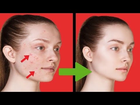 Видео: Уход За Кожей С ЯБЛОЧНЫМ УКСУСОМ