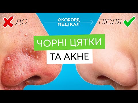 Видео: Акне: як позбутись прищів назавжди? Міфи, лікування та поради дерматолога
