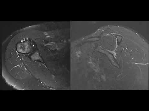 Видео: РУКОВОДСТВО ПО МРТ ПЛЕЧА