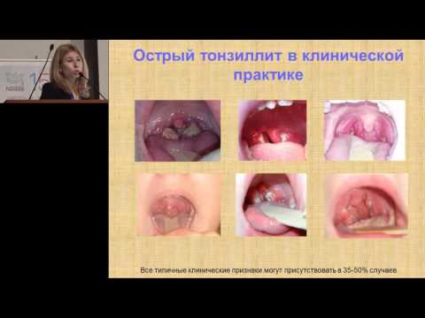 Видео: 14.02.2016 - А.С. Полякова. Острый тонзиллит: взгляд педиатра