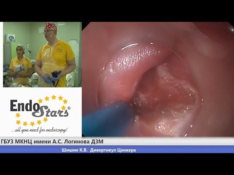Видео: Дивертикул Ценкера, клинический случай №4, МКНЦ 23.01.19