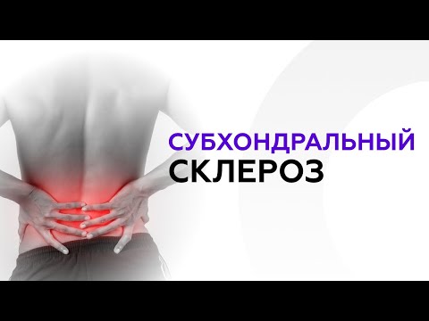 Видео: Врач-ортопед Мусин У.К. о субхондральном склерозе. Медицинский центр Ульфар