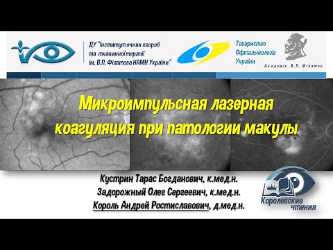 Видео: Микроимпульсная лазерная коагуляция при патологии макулы