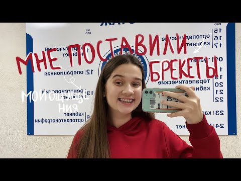 Видео: МНЕ ПОСТАВИЛИ БРЕКЕТЫ! // Как Ставят Брекеты?