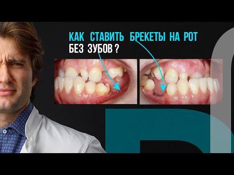 Видео: Как же ставить брекеты на беззубый рот❓