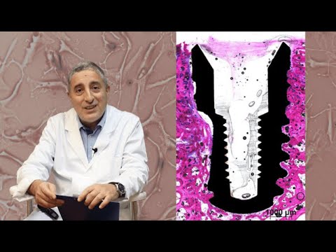 Видео: Остеоинтеграция. Первичная и вторичная стабильность имплантата.