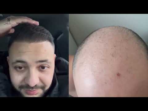Видео: Отзыв после пересадки волос / результат пересадки волос