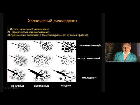 Видео: Ультразвуковая диагностика патологии слюнных желез  Часть 4