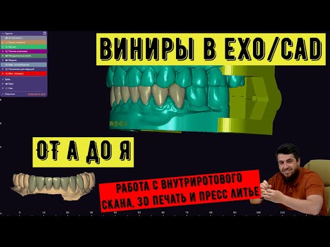 Видео: ВИНИРЫ с уровня интроорального скана - 3shape от сканирования до фиксации. Как делают виниры?