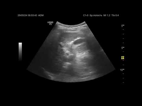 Видео: Ультразвуковая диагностика. Доктор Иогансен. Видеопримеры. Выпуск 78. Фиброзные изменения печени.