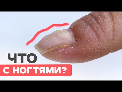 Видео: ДЕФОРМИРОВАННЫЕ ногти | Как исправить без толщины?
