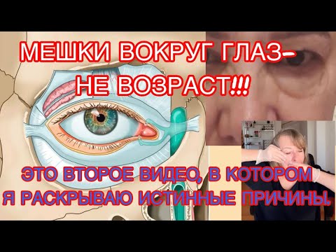 Видео: В ВИДЕО ТЕХНИКА УСТРАНЕНИЯ ПРОБЛЕМЫ: МЕШКИ ПОД ГЛАЗАМИ- СЛЕЗНАЯ ЖИДКОСТЬ НЕ УХОДИТ. КТО БЫ ПОДУМАЛ??