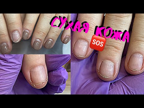 Видео: 😱ЖУТКО СУХАЯ КОЖА❗️ДЕЛАЕМ КОРРЕКЦИЮ| |ТРЕЩИНЫ НА ПАЛЬЦАХ РУК В КРОВЬ, КАК БЕЗОПАСНО ВСЕ УБРАТЬ ⁉️