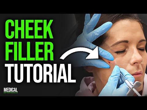 Видео: Филлер для щек для идеальной подтяжки средней части лица | Полная демонстрация процедуры