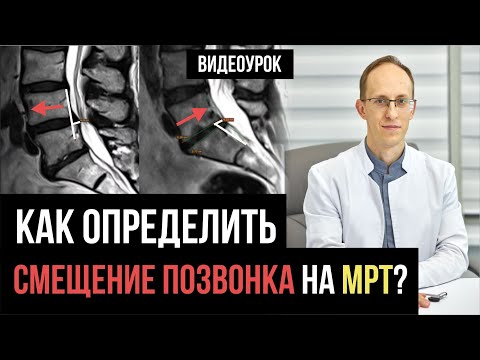 Видео: Антелистез и ретролистез поясничном отделе