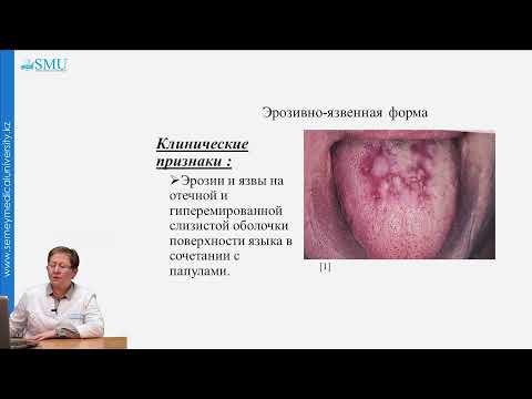 Видео: Красный плоский лишай (КПЛ)