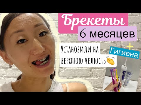 Видео: УСТАНОВИЛИ БРЕКЕТЫ НА ВЕРХНЮЮ ЧЕЛЮСТЬ💃 6 МЕСЯЦЕВ НА НИЖНЕЙ🥂//МОЙ УХОД ЗА ЗУБАМИ🪥🦷