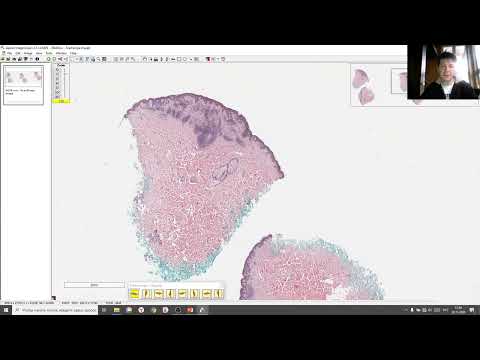 Видео: Рецидивирующий невус