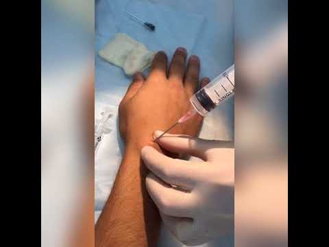 Видео: Пункционной метод  лечение гигромы кисти в Уфе