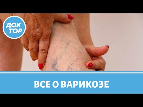 Видео: Кому грозит варикозная болезнь вен? Ответы на часто задаваемые вопросы