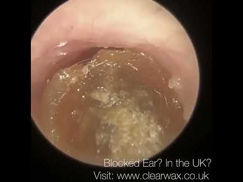 Видео: 1608 — Пожалуйста, прекратите использовать ватные палочки для удаления ушной серы