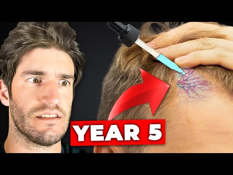 Видео: Телемедицина при выпадении волос — это катастрофа! 3 примера серьёзного вреда