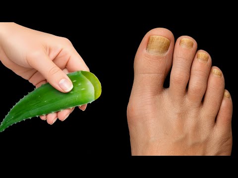 Видео: 🔥 Грибы исчезают у вас на глазах! 100-летний рецепт алоэ, который действительно работает!